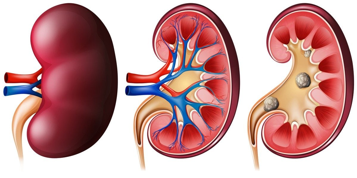 living kidney donor risks