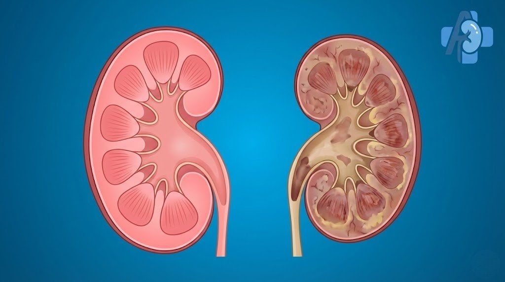 Kidney Dialysis